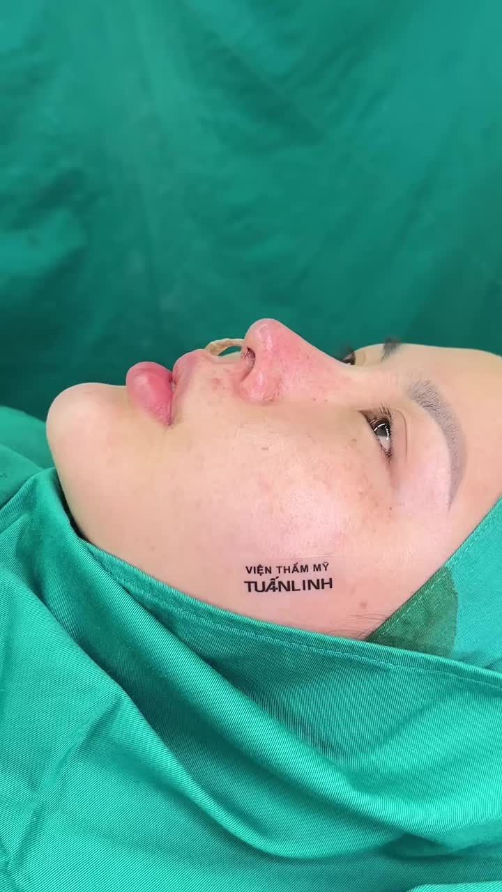 Case nâng mũi tái cấu trúc sau 90 phút