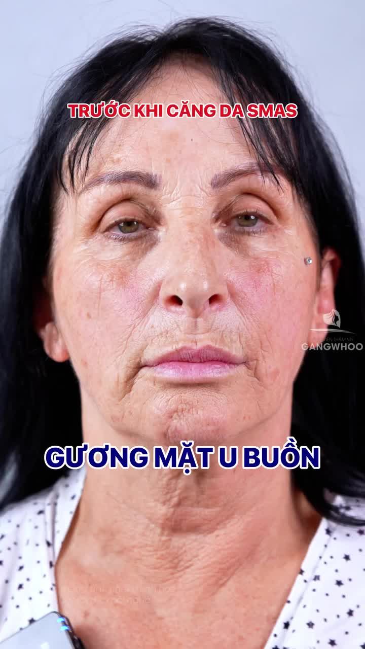 Thu hồi 20 tuổi chỉ với phương pháp căng da Smas