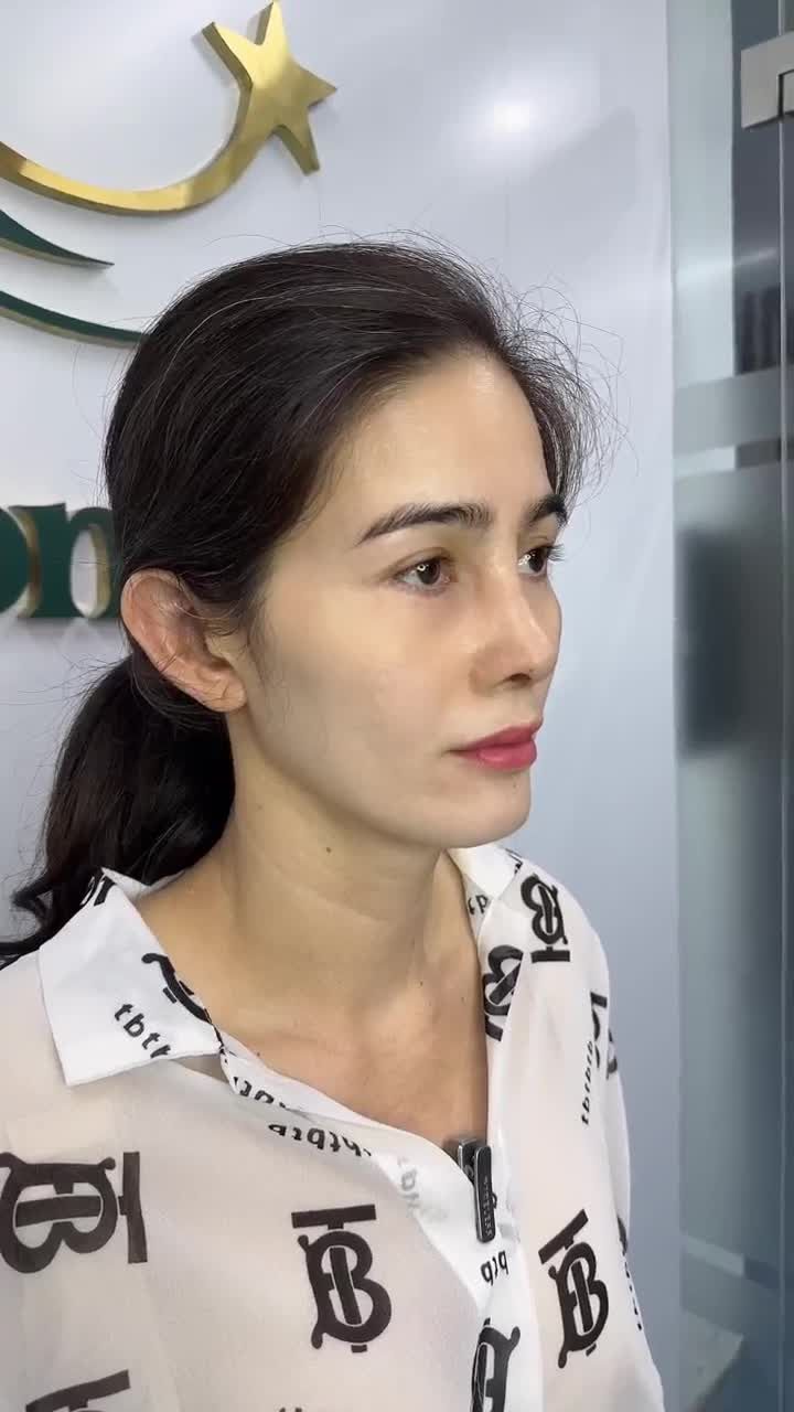CẬN CẢNH DÁNG MŨI CẤU TRÚC DR.HOẠT SAU 10 NGÀY