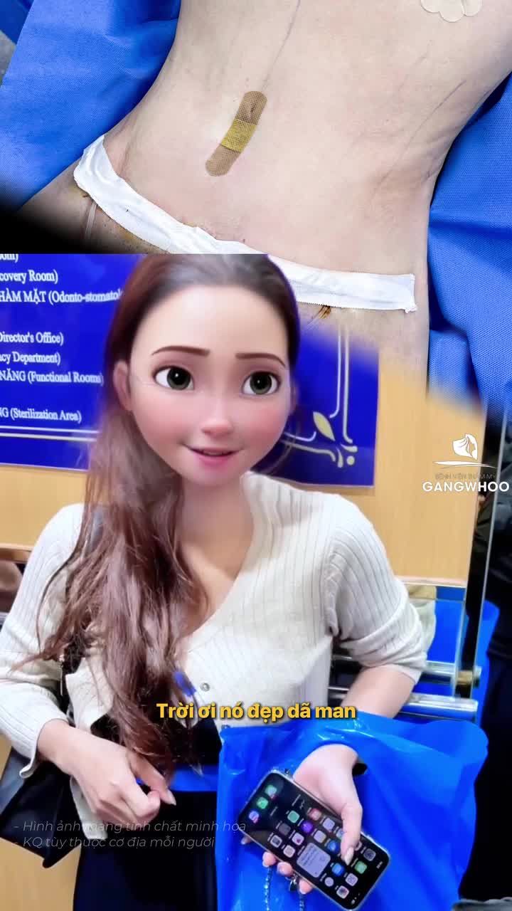 Chị khách căng da bụng 4 ngày đích thân chia sẻ trải nghiệm cho chị khách chuẩn bị căng da bụng tại thang máy Gangwhoo