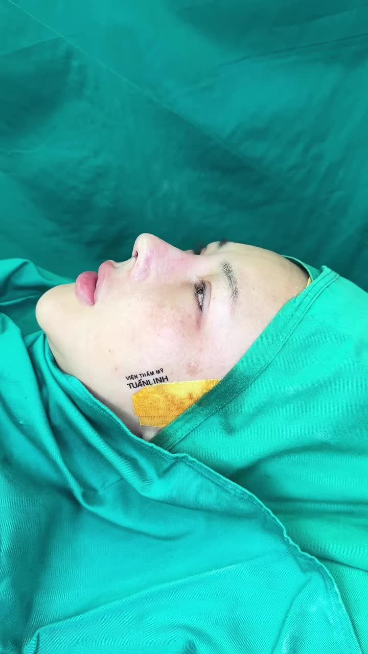 Case nâng mũi tái cấu trúc Surgiform