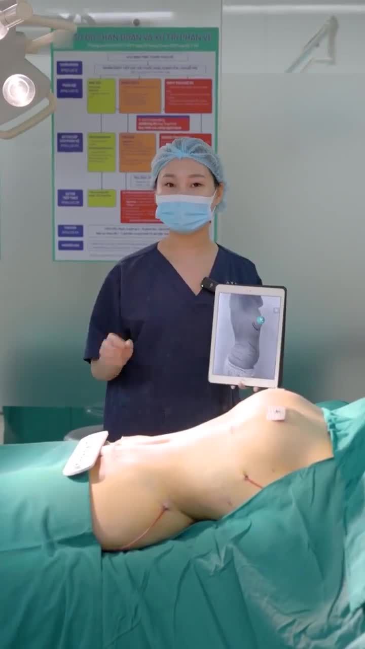 Combo nâng V1 Ergonomix size 300cc kết hợp loại bỏ mỡ thừa vùng bụng – hông – eo cho khách hàng sinh năm 2002.