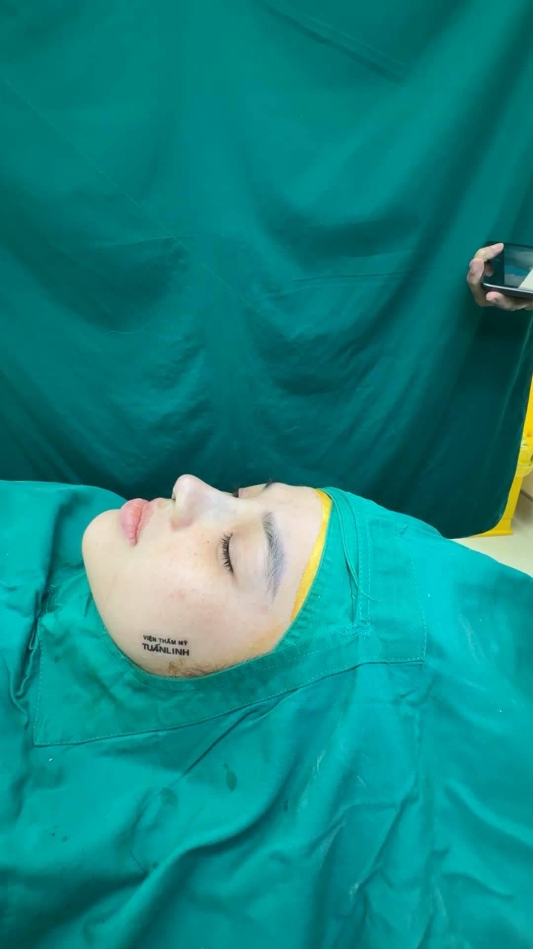 Case nâng mũi cấu trúc sửa lại sụn sinh học Mỹ vừa hoàn thành đẹp xuất sắc.