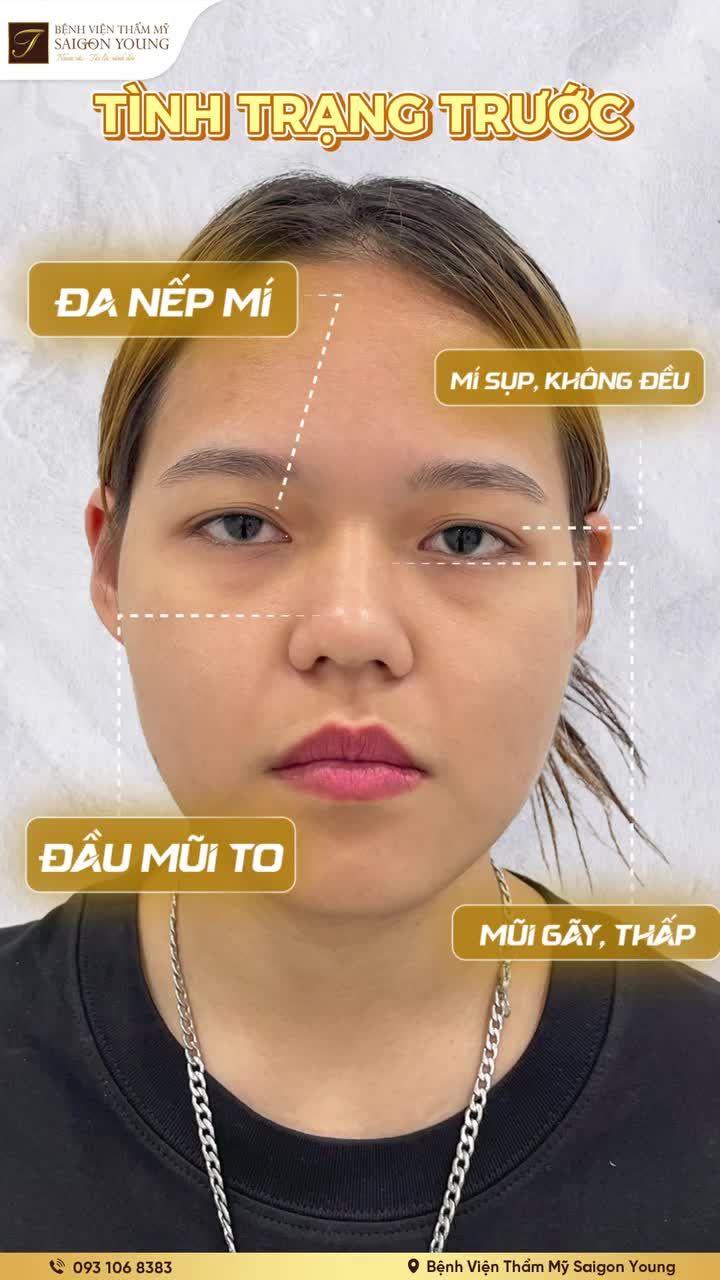 Việt kiều Anh 2K4 “lột xác” ngoạn mục sau combo Mắt - Mũi tại Saigon Young