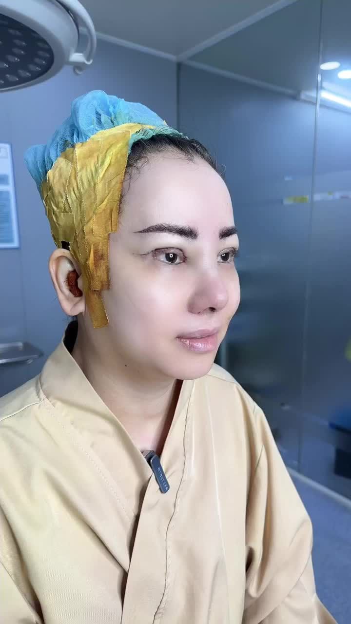 KẾT QUẢ SAU KHI NÂNG MŨI VÀ CẮT MÍ MẮT KH: PE MENG CHUAN (ĐÀI LOAN)