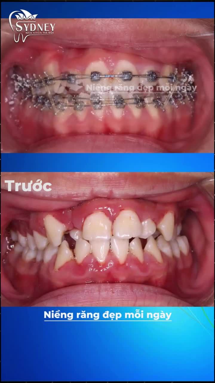 Các trường hợp không thể niềng răng. Bạn đã biết chưa?