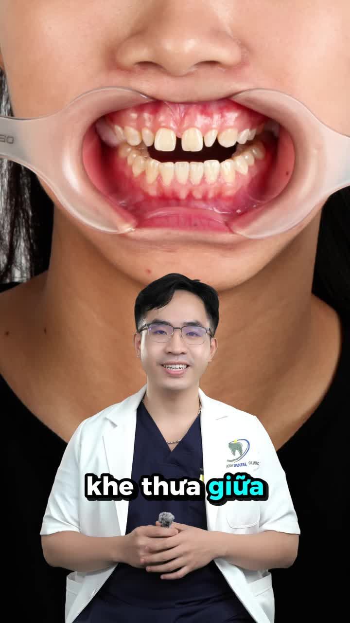 Tạm biệt khe thưa răng cửa – Tự tin nụ cười rạng rỡ!