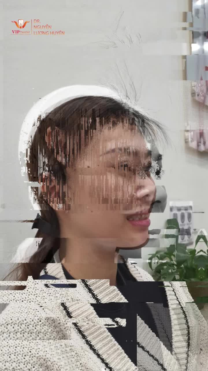 Niềng răng thay đổi từ nụ cười đến gương mặt như thế nào?