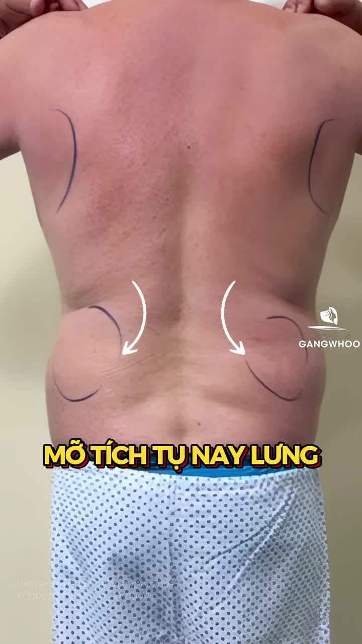 Dáng bụng của anh khách đến từ Pháp cải thiện ra sao sau khi đến BVTM Gangwhoo?