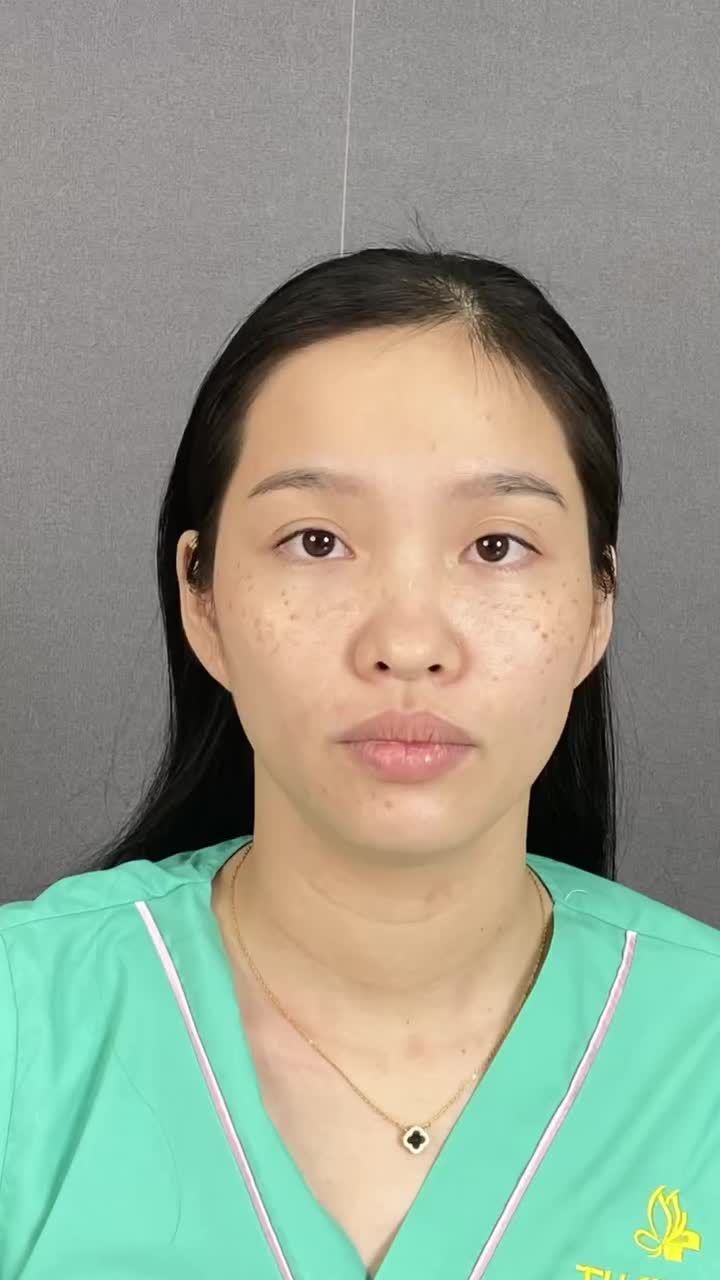 Nâng mũi - Trẻ hóa gương mặt, thanh tú, đẹp tự nhiên, cải thiện  phong thủy.