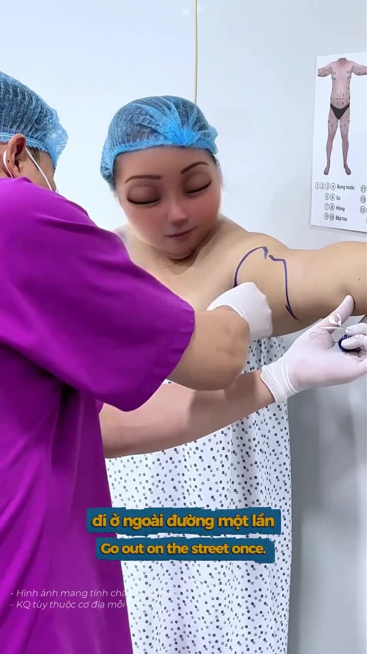 Hút mỡ bắp tay xong chị khách đánh giá nhẹ nhàng, có thể về ngay trong ngày