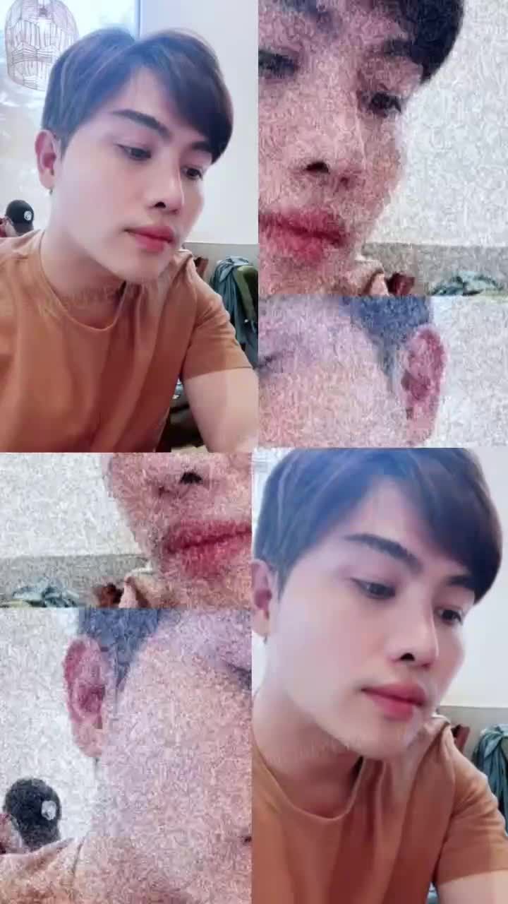 Sau khi hoàn thiện dịch vụ mũi lót sụn kết hợp cắt cánh mũi, gương mặt chàng khách trở nên hài hòa và sáng sủa hơn hẳn.