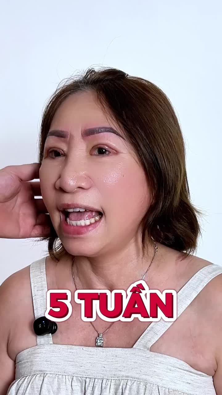 64 tuổi sau khi căng da mặt trẻ như gái 50