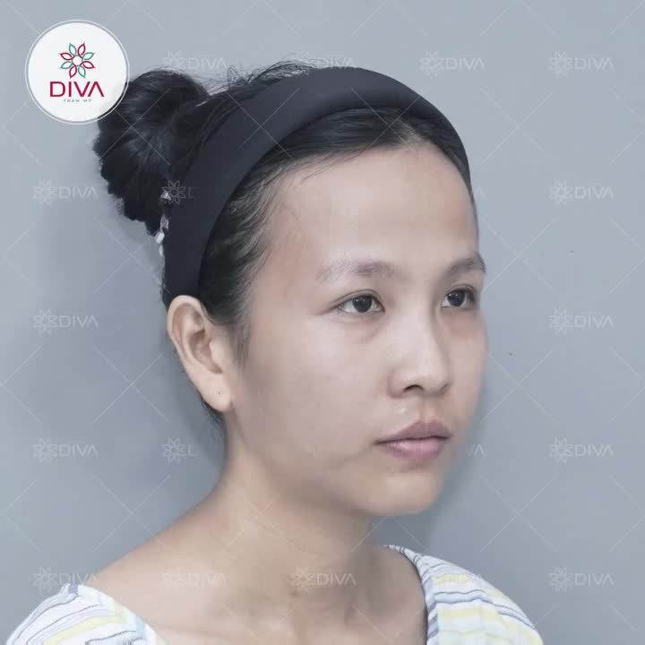 "SỨC MẠNH" CỦA VIỆC GIẢI THOÁT ĐÔI MẮT KHỎI TÚI MỠ MẮT NẶNG NỀ VÀ KHUYẾT LÕM MẮT DƯỚI!