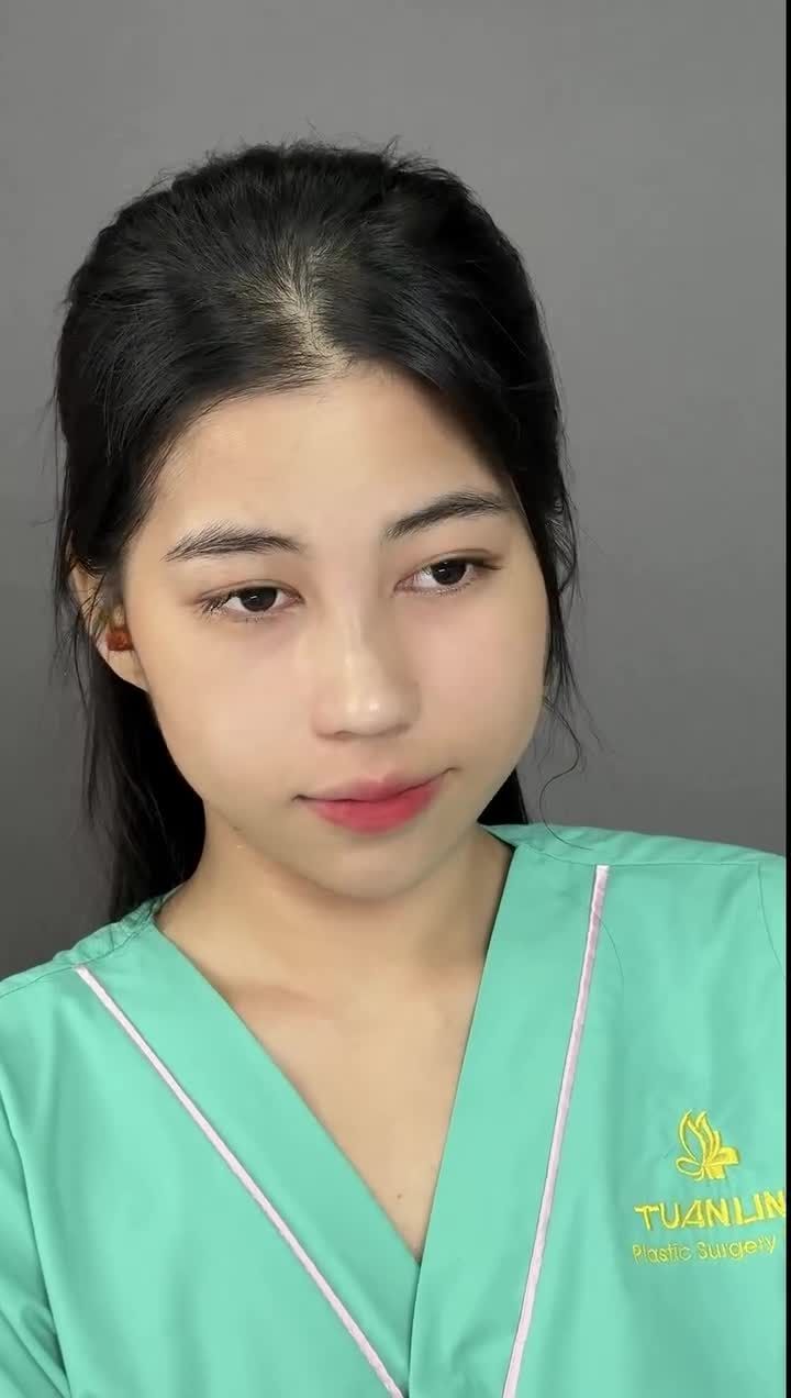 Bé khách siêu xinh đẹp sau 90 phút nâng mũi cấu trúc.