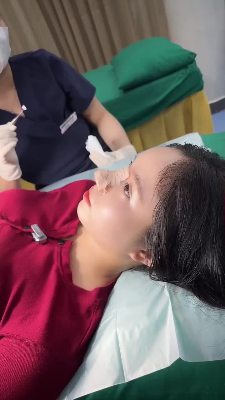 THÁO NẸP SAU 10 NGÀY NÂNG MŨI - LỘ DIỆN DÁNG MŨI CỰC PHẨM