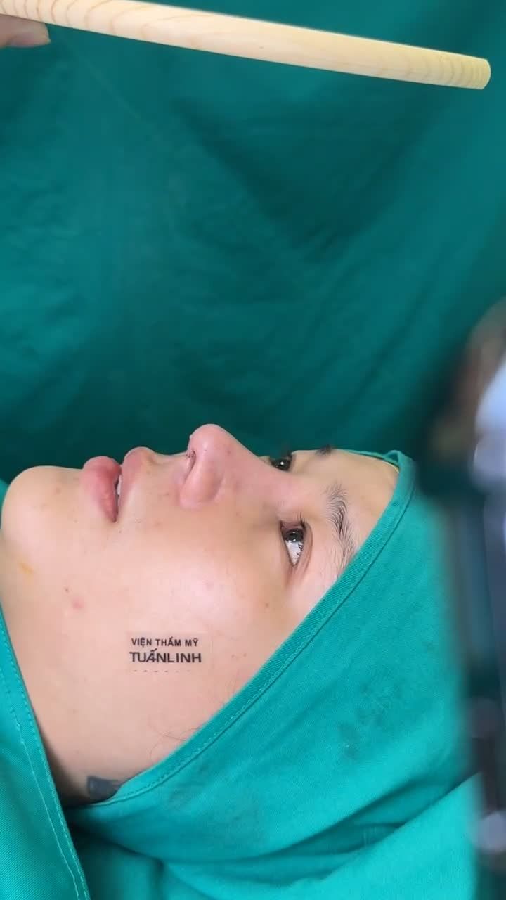Mũi câu trúc sửa lại vừa hoàn thành - Dáng mũi tự nhiên, đầu mũi cao bay phong thủy.