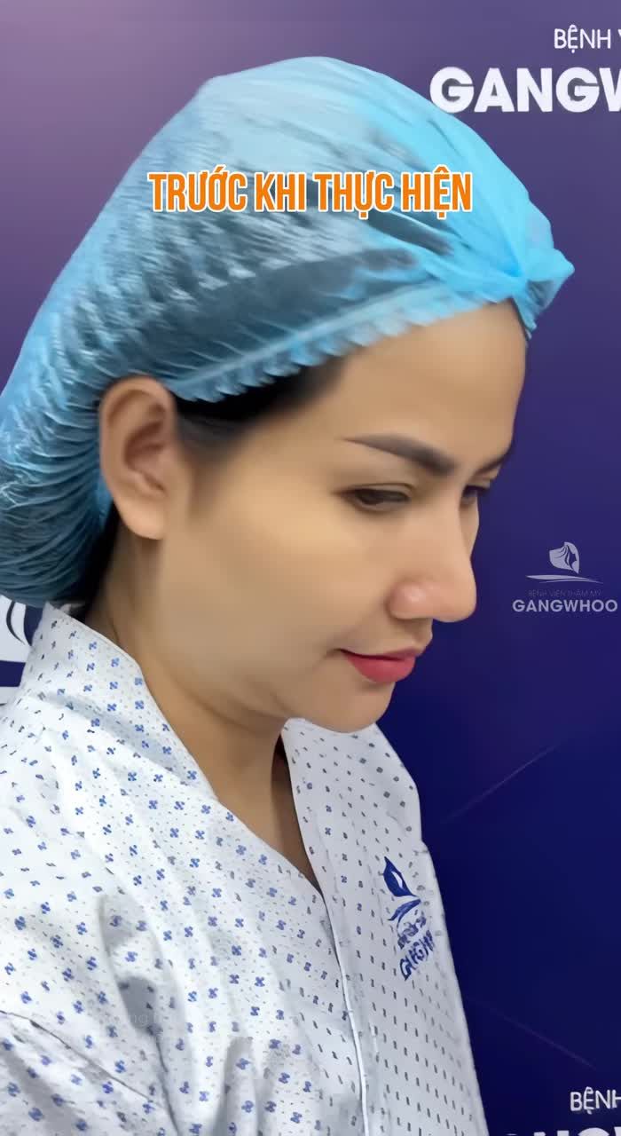 Nói không với làn da chảy xệ ở làn da U40 sau căng da mặt Smas nội soi 4K