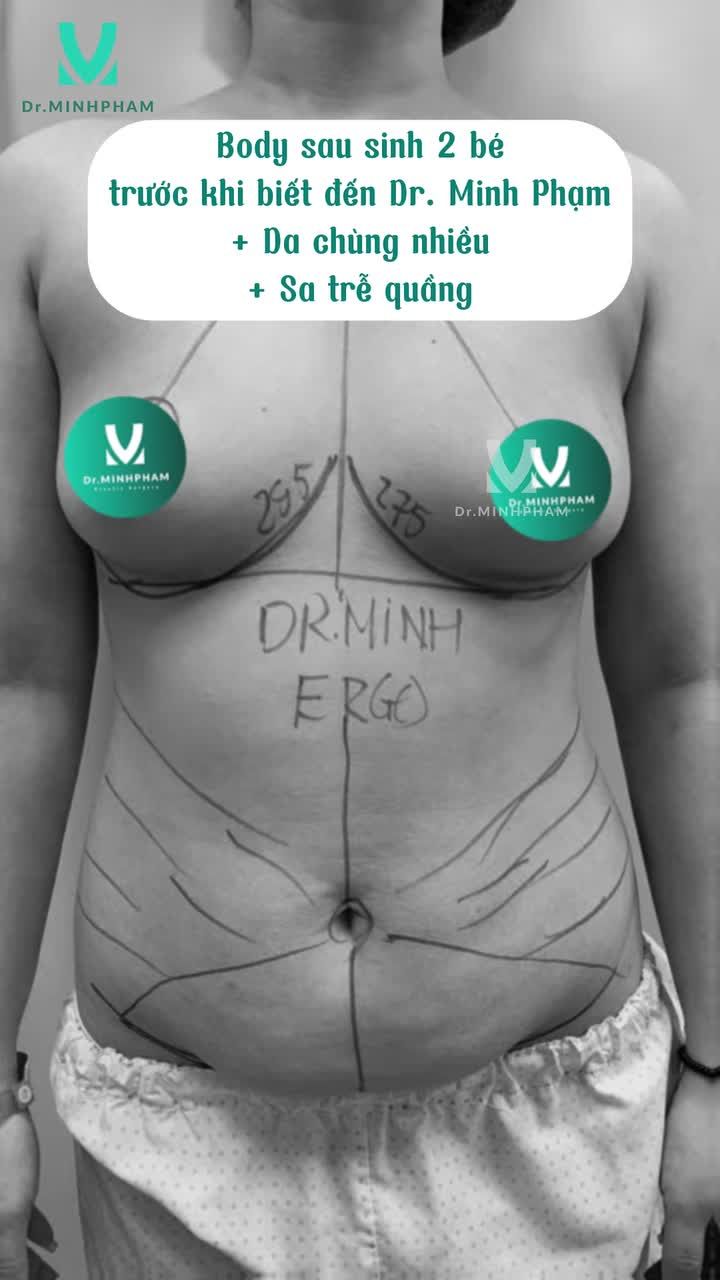 ĐỘ LẠI BODY BỐC LỬA VỚI COMBO HÚT MỠ + NÂNG NGỰC