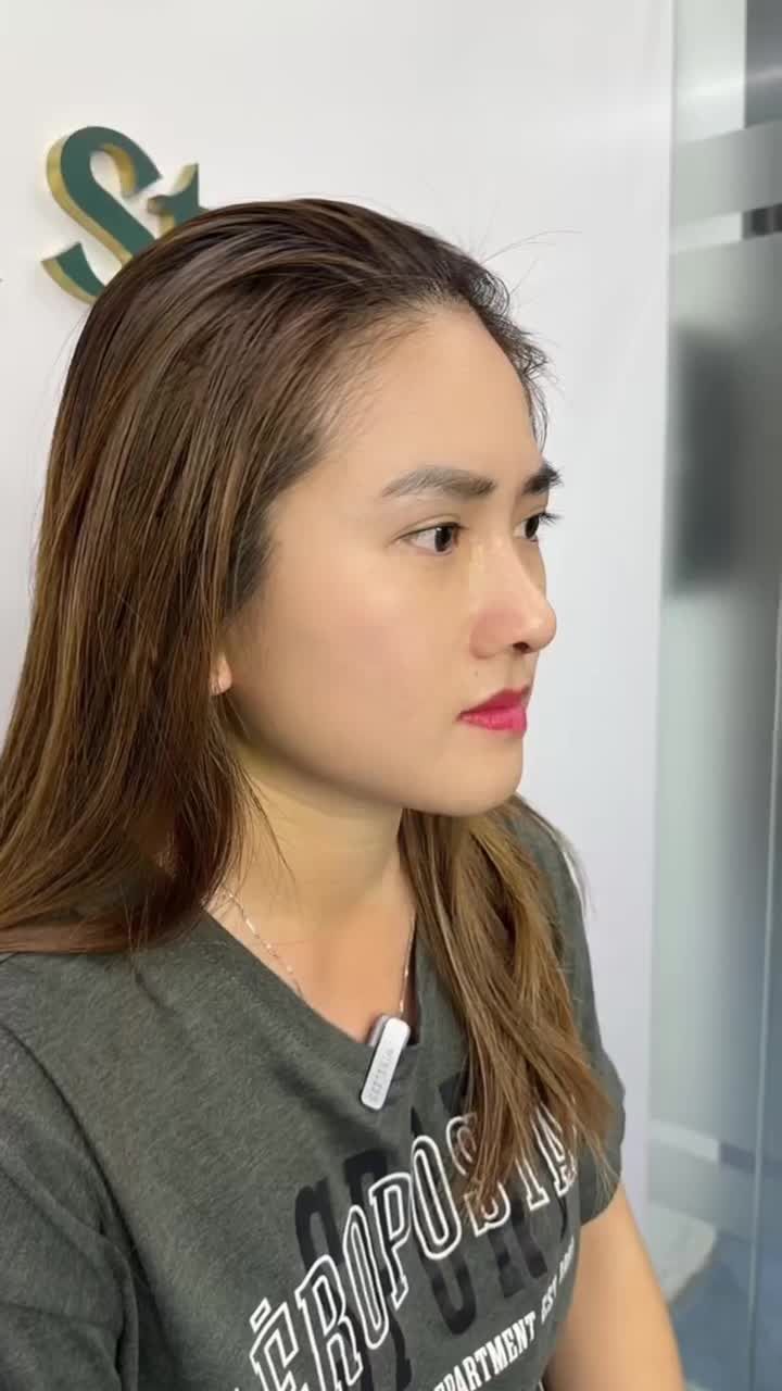 KHÁCH HÀNG SAU 10 NGÀY NÂNG MŨI TẠI SAIGON STAR