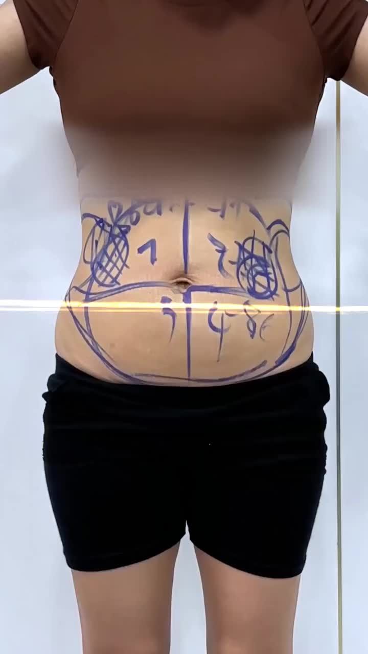 Chị khách vừa hút mỡ toàn bụng thoải mái đi lại, không đau có thể ra về ngay