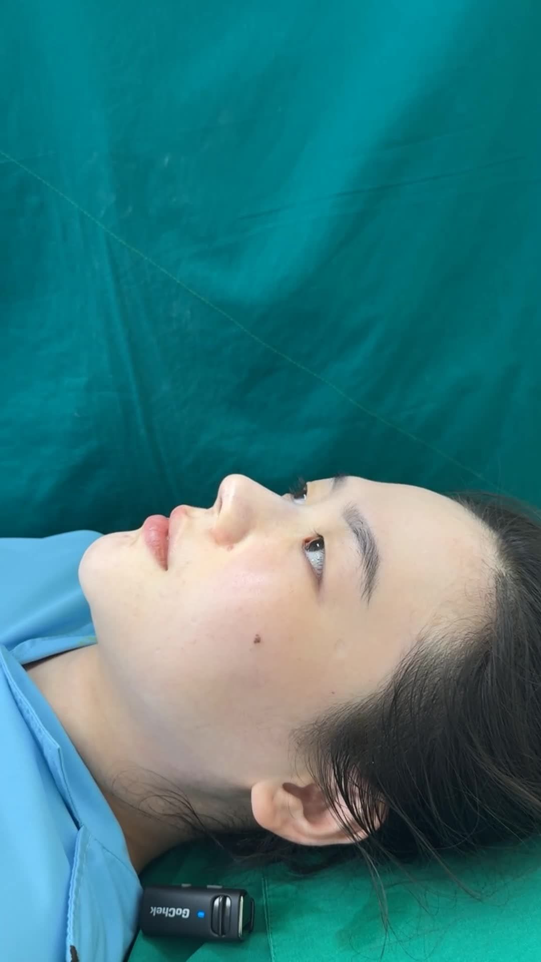 Case Nâng mũi bọc sụn - Dáng mũi tự nhiên, hài hòa, cân đối.