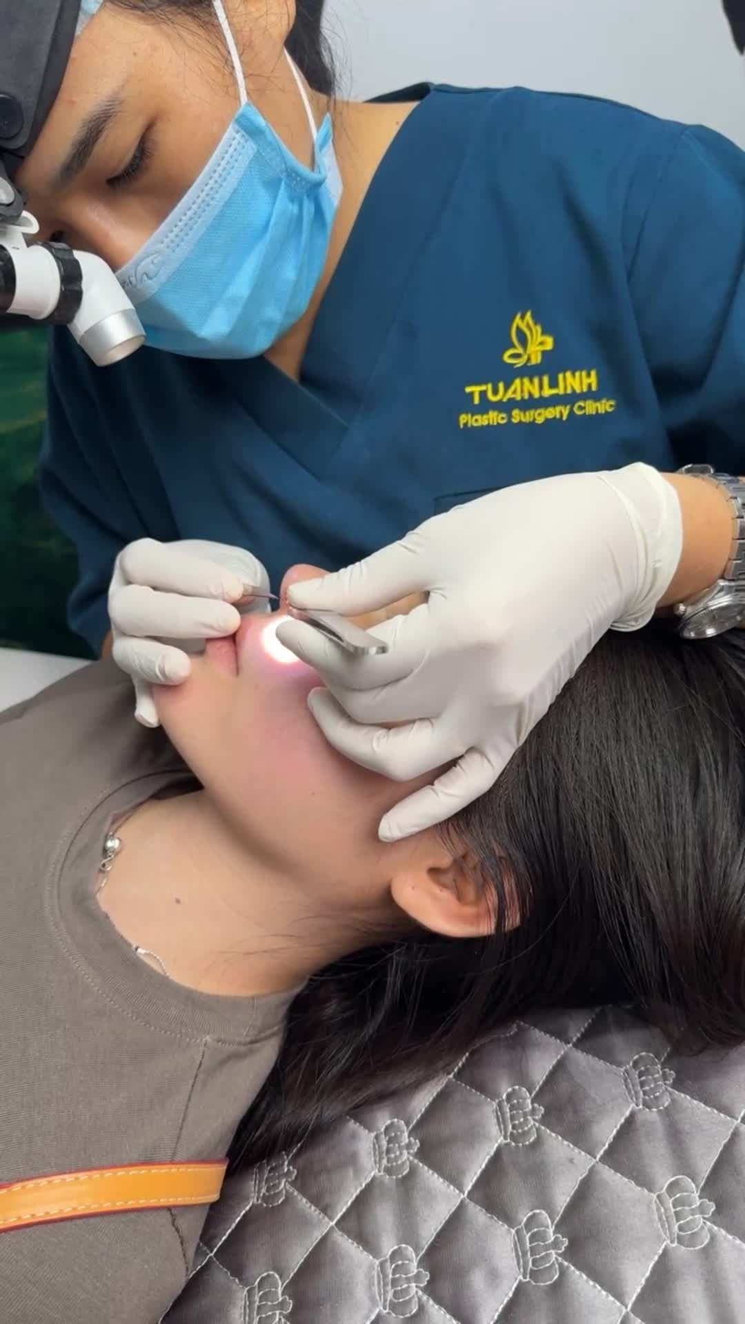 Mũi cấu trúc sau 7 ngày tái khám - Dáng mũi đã ôm form chuẩn đẹp tự nhiên.