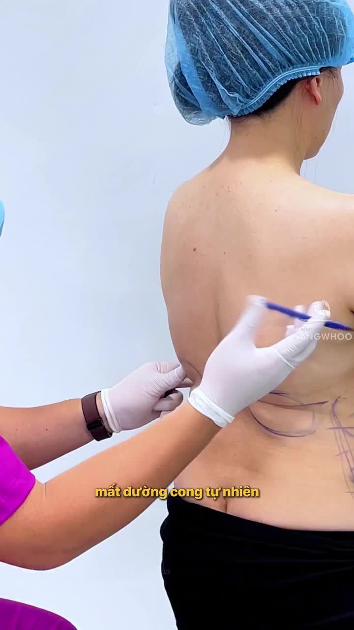 Mỡ lưng tích tụ, chị khách tìm đến Lipo Ultrasound để giải quyết và kết quả sau 7 ngày thực hiện