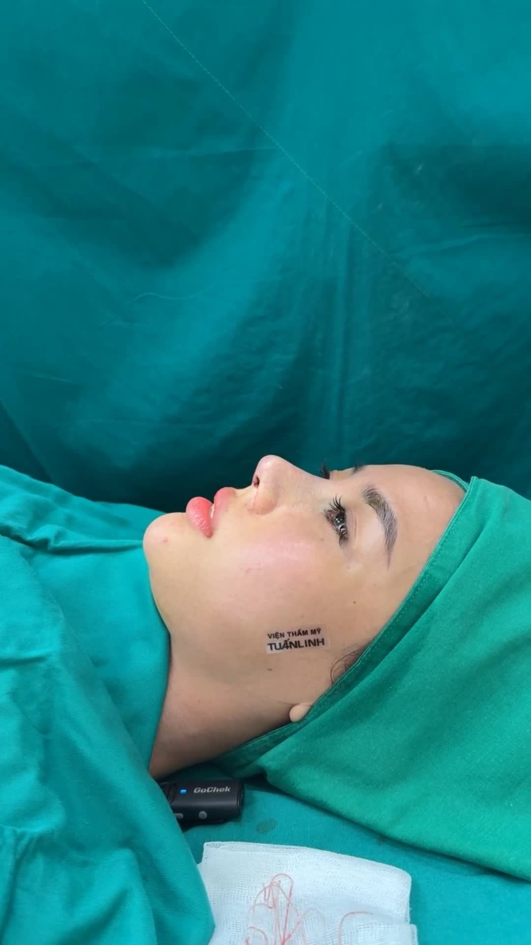 Mũi cấu trúc rút chỉ sửa lại Surgiform vừa hoàn thành - Dáng mũi hài hòa, tự nhiên.
