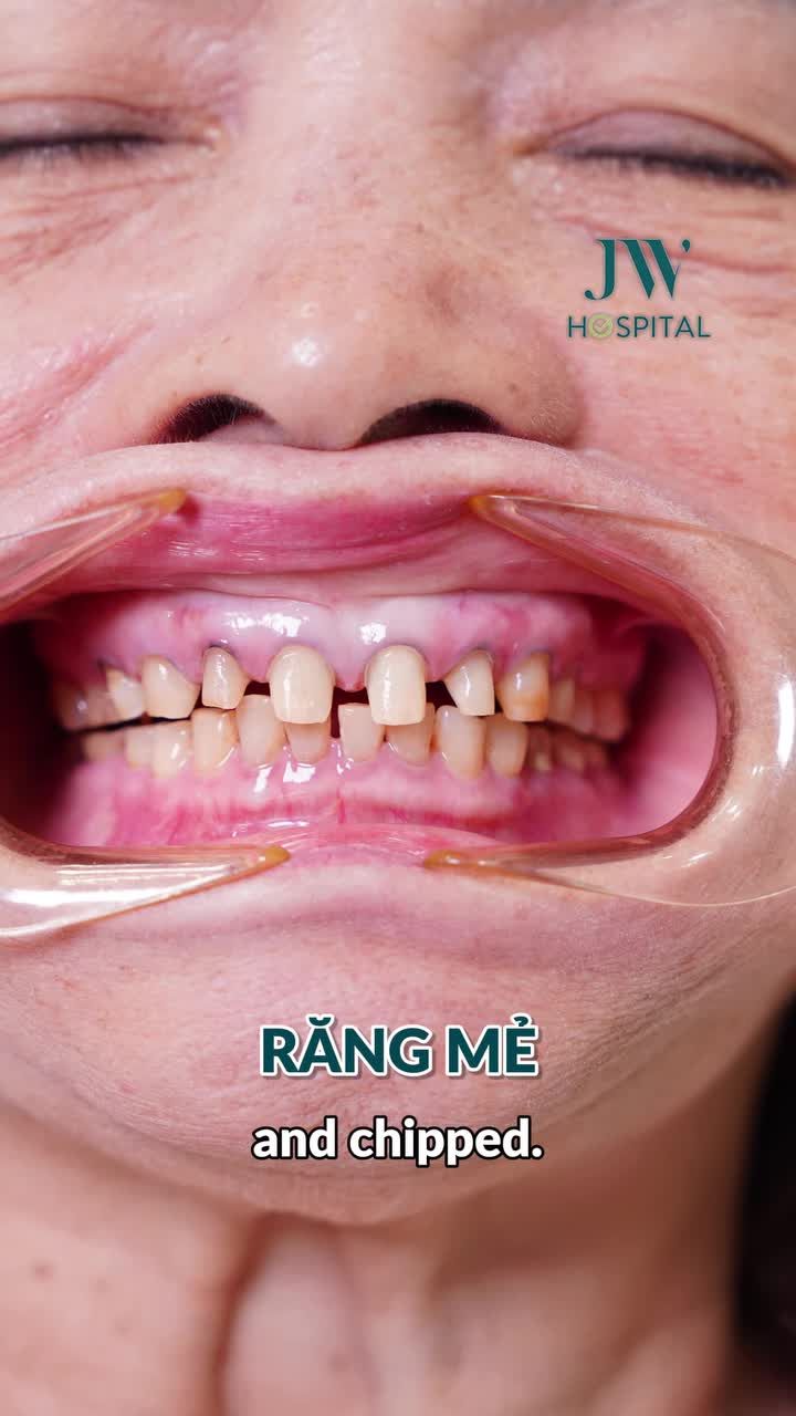 VIỆT KIỀU MỸ CHI 100 TRIỆU BỌC RĂNG SỨ TOÀN HÀM ĐẸP SANG CHUẨN ĐẠI GIA