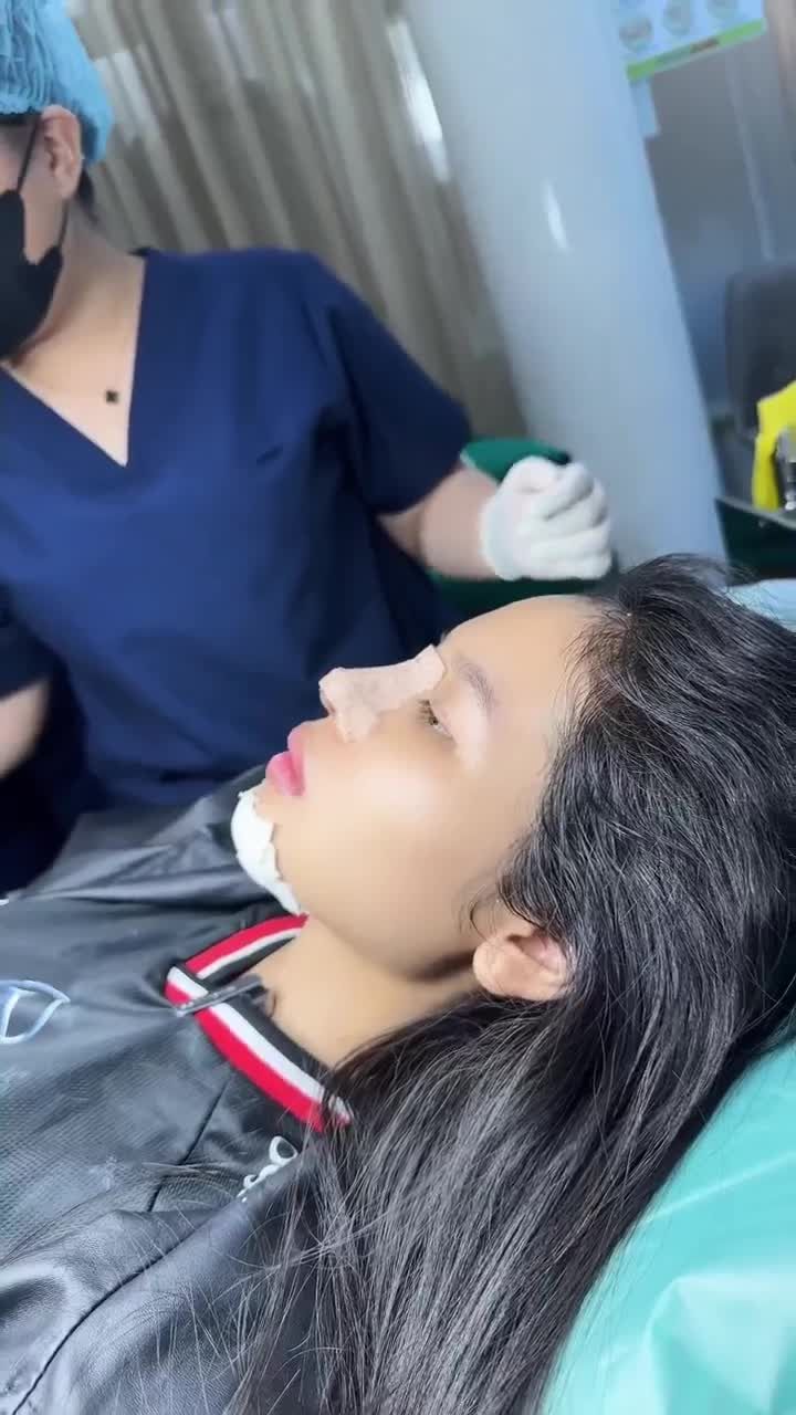 DÁNG MŨI SAU KHI THÁO NẸP SẼ RA SAO???