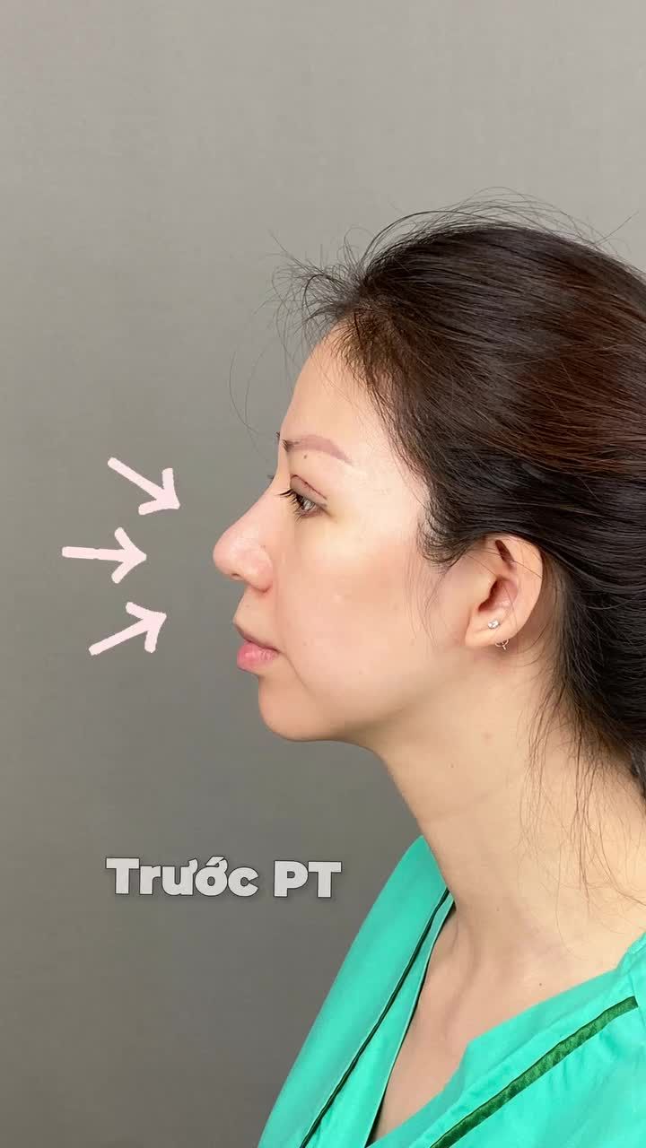 Nâng mũi bị thiếu cằm làm gương mặt chưa thật được hoàn hảo!! Giải pháp Độn cằm Vline sẽ giúp khắc phục khuyết điểm đó!!
