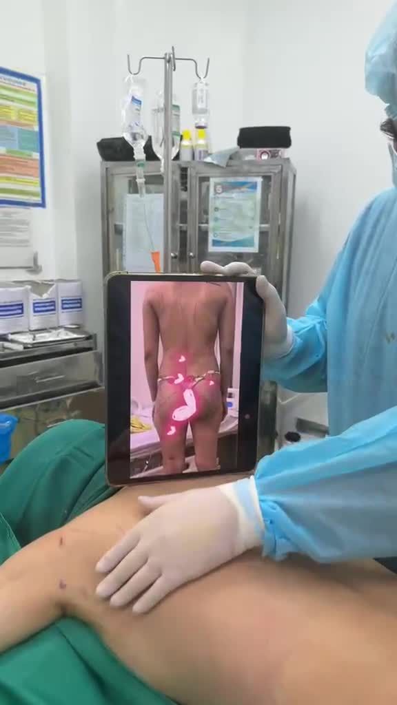 Hút mỡ cánh tay, lưng, siết hông-eo, hút mỡ đùi và cấy mỡ mông cho bạn gái Đà Nẵng