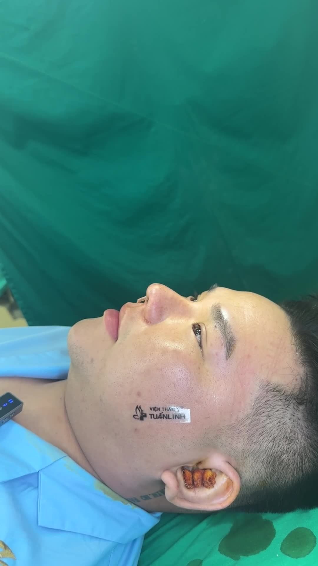 Case mũi tái cấu trúc cho bạn nam từ sóc trăng