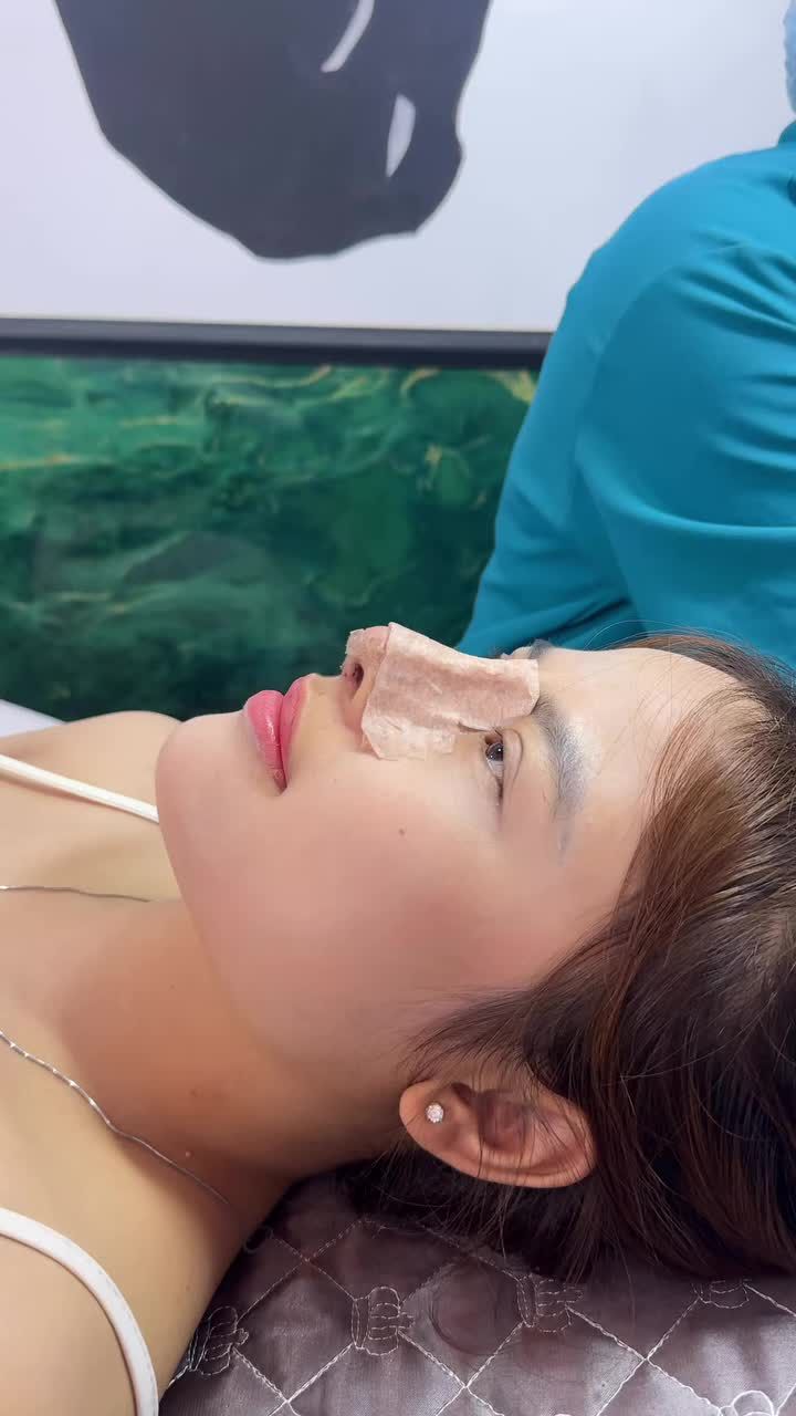 Case mũi tái cấu trúc sụn Surgiform sau 10 ngày tái khám!!