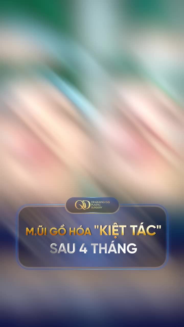MŨI GỒ HÓA "KIỆT TÁC" SAU 4 THÁNG