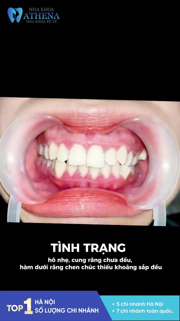 Nụ cười thay đổi, thần thái cũng khác biệt. Thúy Kiều (2002) đã chính thức khép lại hành trình niềng răng tại Athena với kết quả rực rỡ