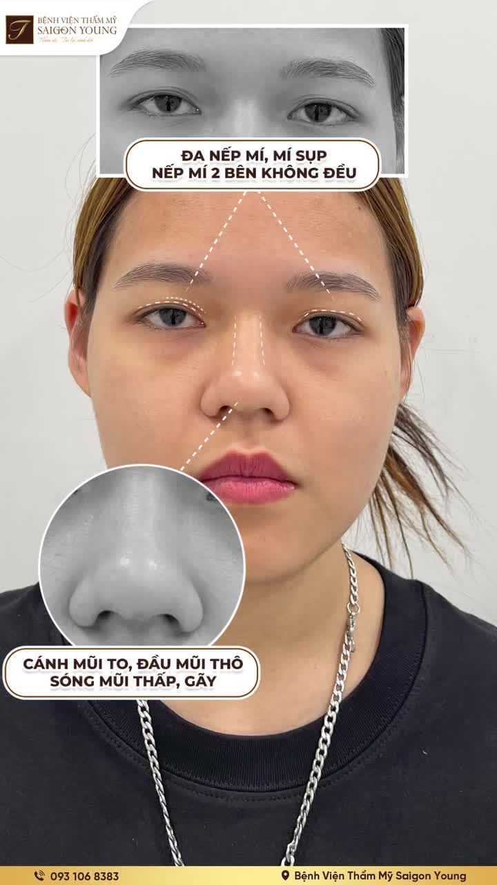 Thăng hạng nhan sắc với bộ đôi Nâng mũi Cắt mí tại Saigon Young
