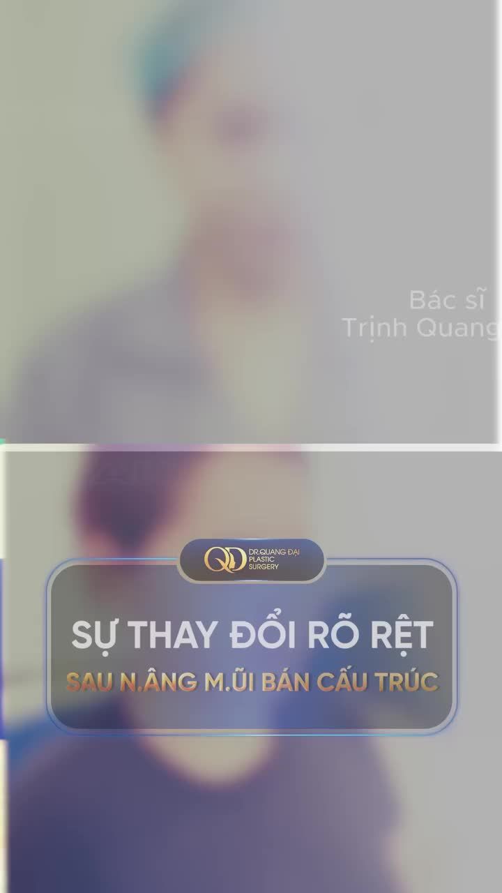 SỰ THAY ĐỔI RÕ RỆT SAU NÂNG MŨI CẤU TRÚC