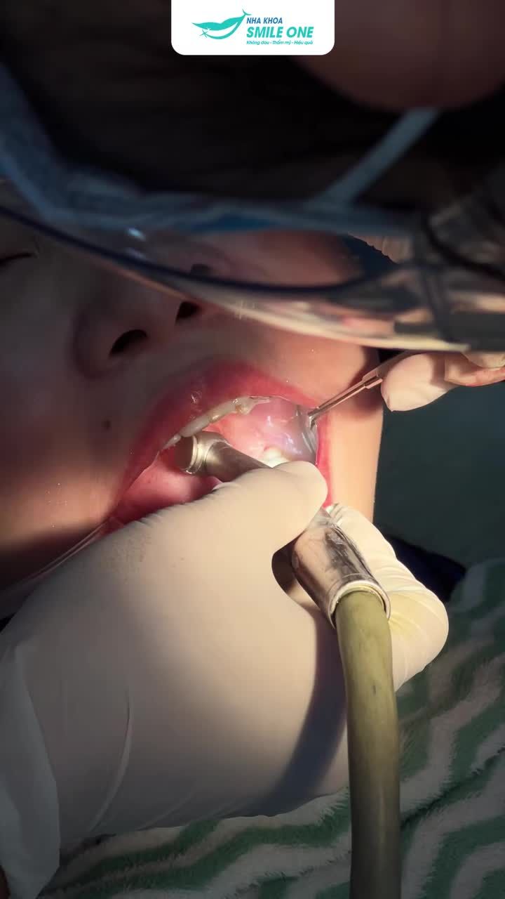 Nhổ răng 8 ư? Quá dễ với BS Quyên nhà Smile One!