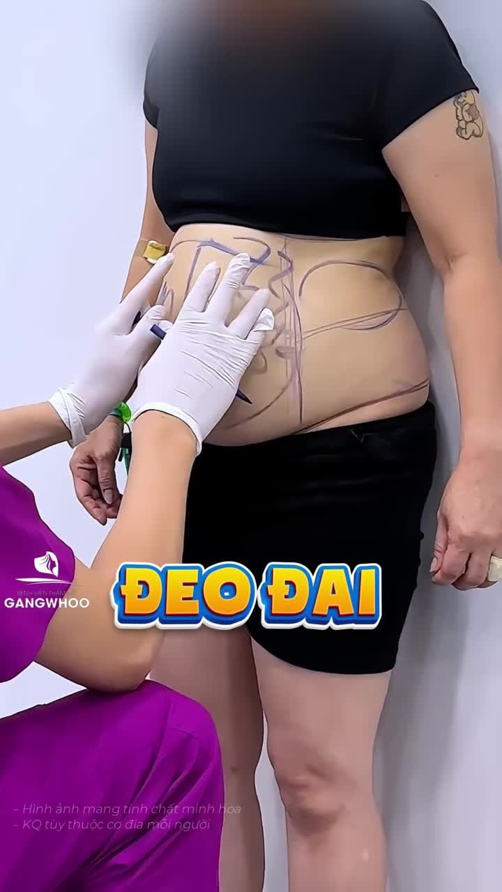 Bụng có cơ bụng phình, mỡ tích tụ cứng đầu sau 7 ngày giảm mỡ Lipo Ultrasound sẽ ra sao