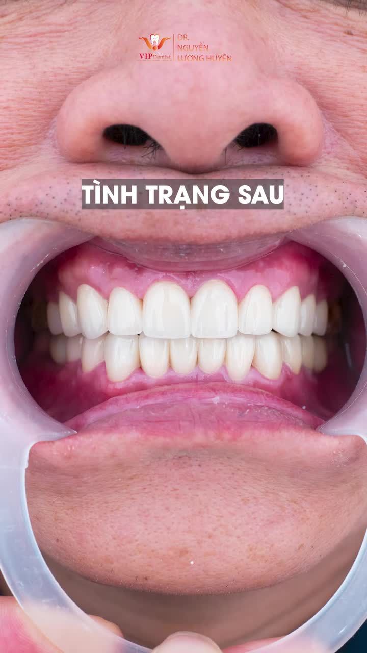 Từ một hàm răng ố vàng với nhiều bệnh lí,  chú Thái Thọ Vinh đã quyết định “lột xác” để sở hữu nụ cười rạng rỡ, khỏe mạnh và tự tin hơn bao giờ hết.