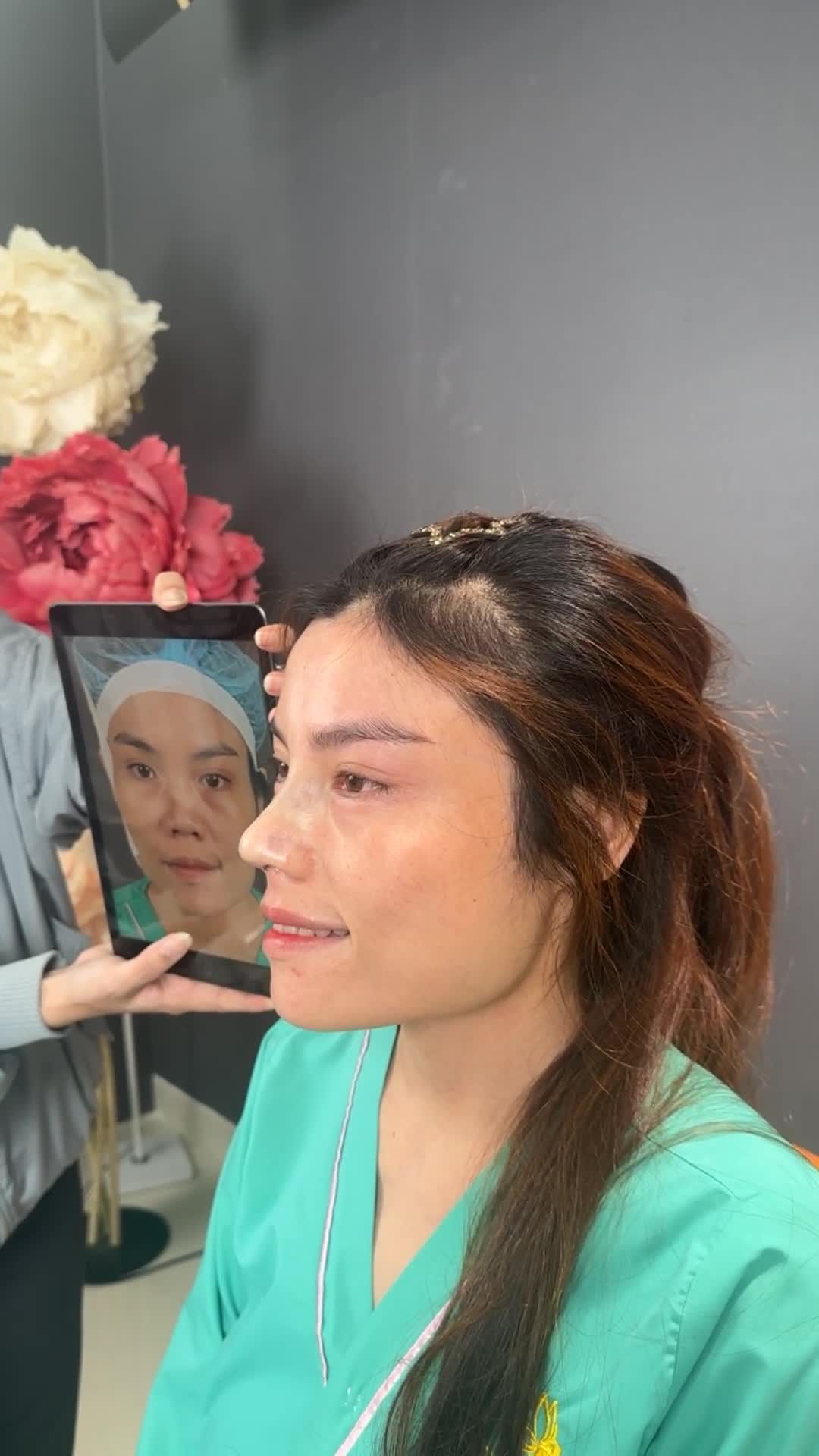 Ca nâng mũi cấu trúc surgiform vừa hoàn thành - Dáng mũi cao đẹp thanh tú.
