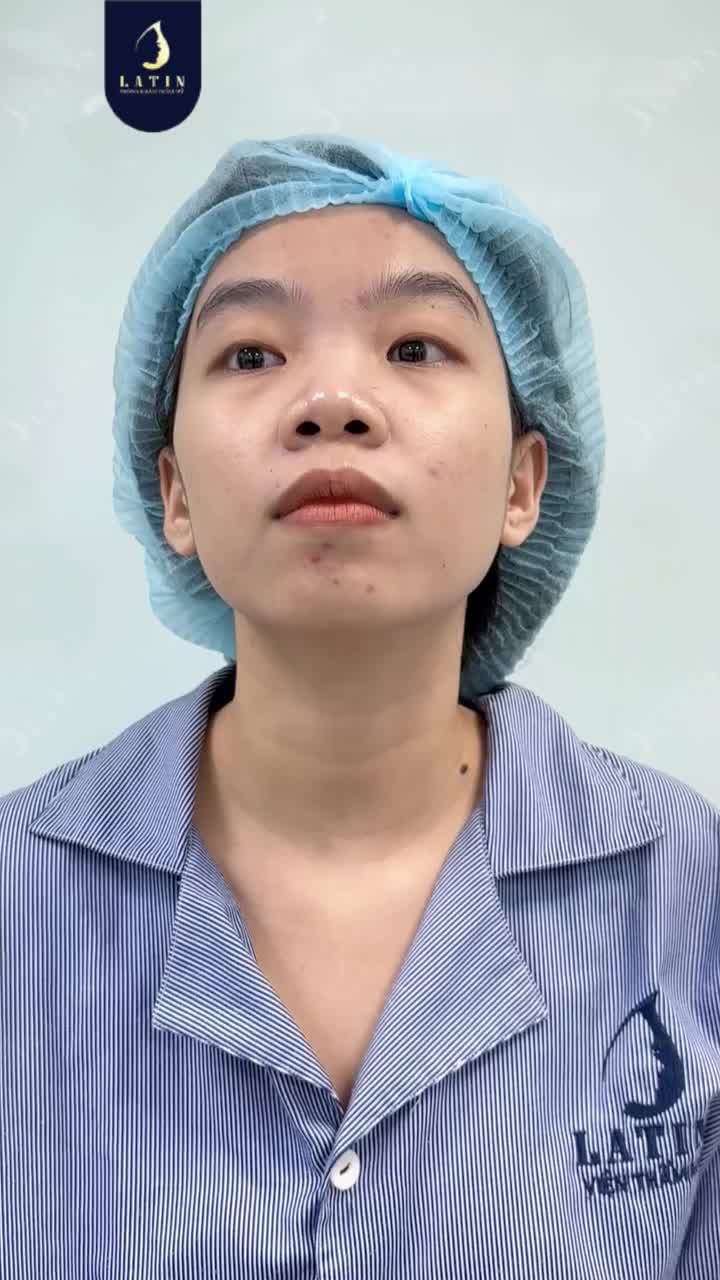TỪNG TỰ TI VÌ DÁNG MŨI THẤP GIỜ ĐÃ TỰ TIN SAU 10 NGÀY