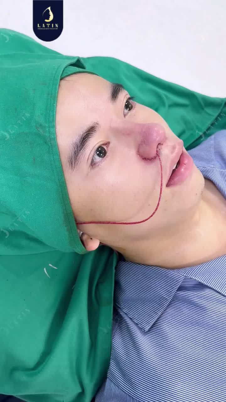 ĐỔI MŨI THÔ TO LẤY MŨI NAM TÍNH LỊCH LÃM