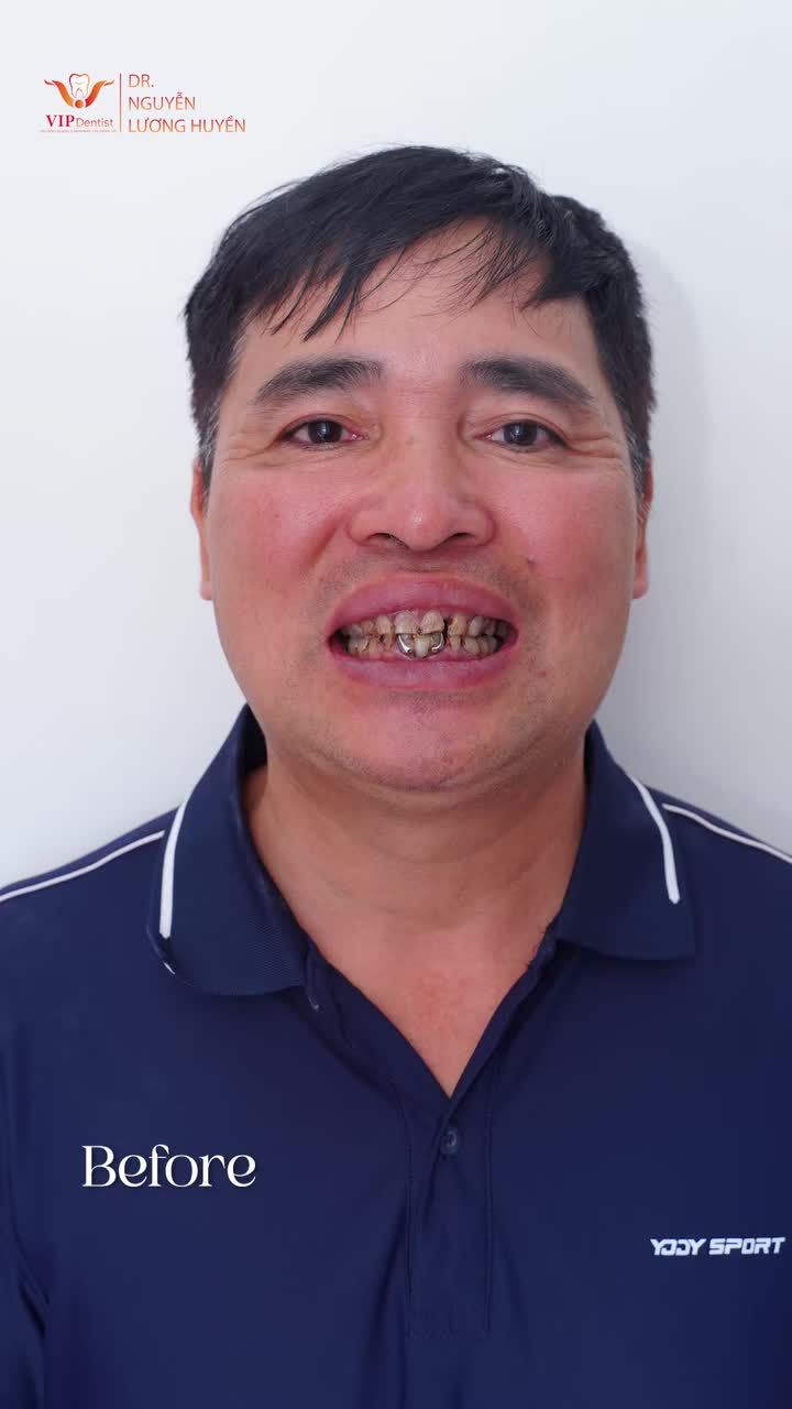 Chỉ với phương pháp thẩm mỹ răng sứ, VIP Dentist đã khắc phục hoàn toàn các khuyết điểm trên răng của nam khách hàng