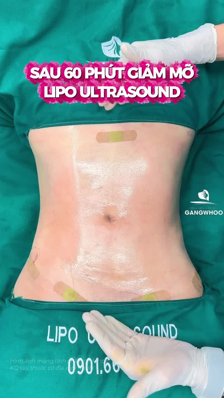 Chị khách đã tìm hiểu kỹ các phương pháp giảm mỡ trên thị trường trước khi đến BVTM Gangwhoo như thế nào?