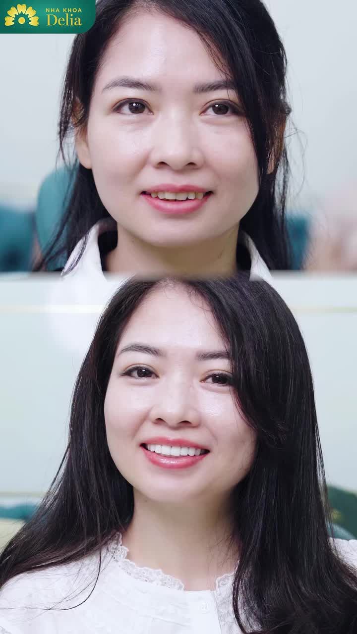 Nhiều lần soi gương, chị chỉ ước: “Giá mà mình có thể tự tin mỉm cười mà không cần giấu đi nụ cười ấy.”