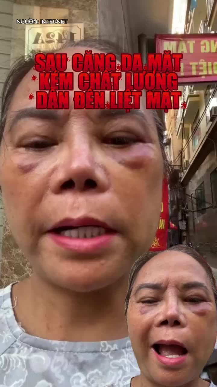 Lời cảnh tỉnh cho các chị em khi căng da mặt giá rẻ dẫn đến biến chứng liệt mặt