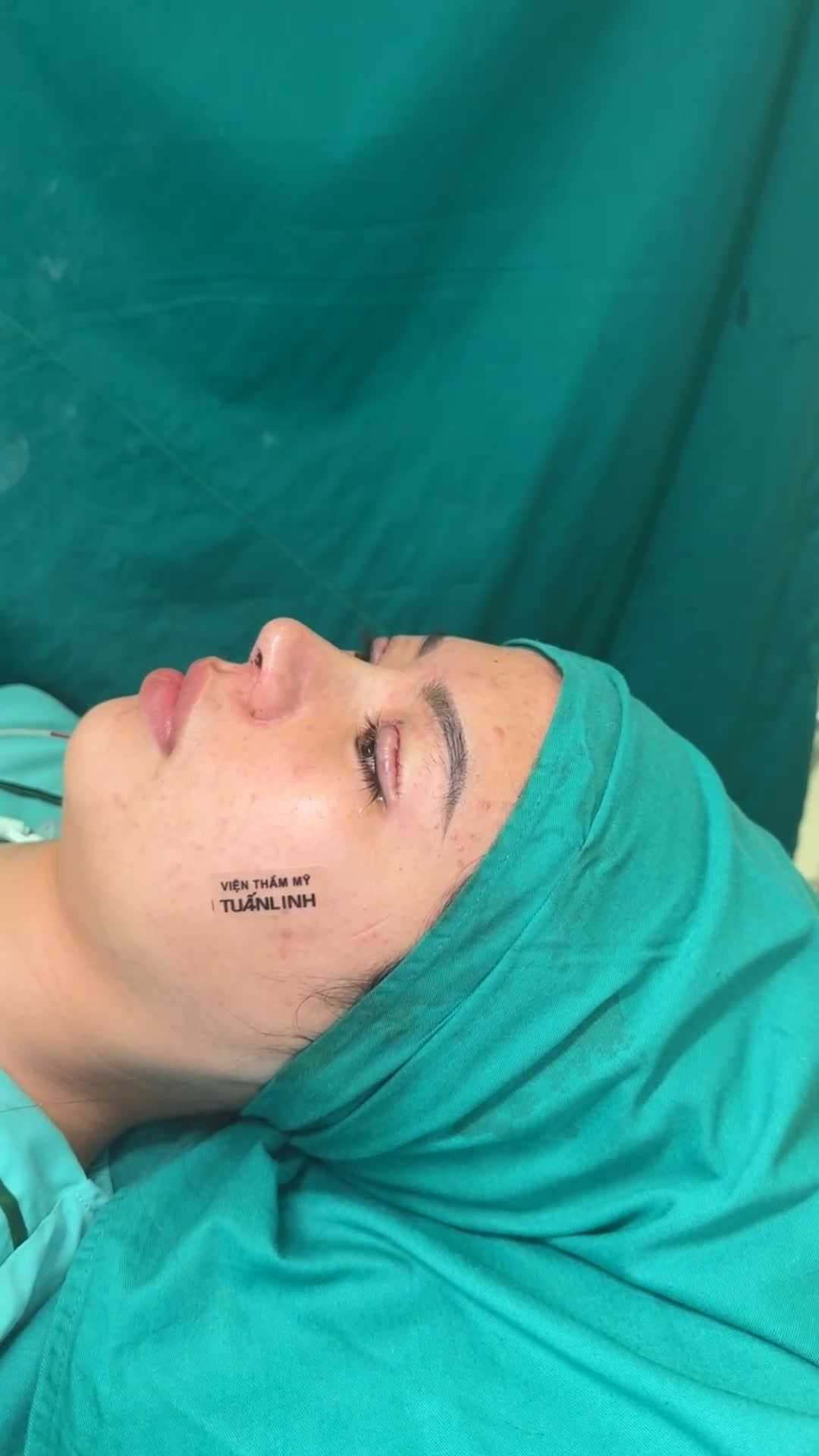 Case combo mũi cấu trúc Surgiform và cắt mí !!